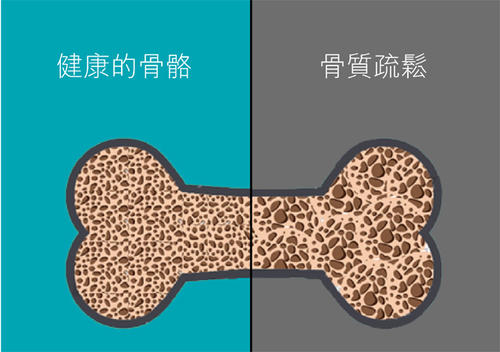 老年人骨质疏松易导致骨折之超声91视频下载免费检查仪的临床价值是什么? 老年人骨质疏松易导致骨折之超声91视频下载免费检查仪的临床价值是什么?
