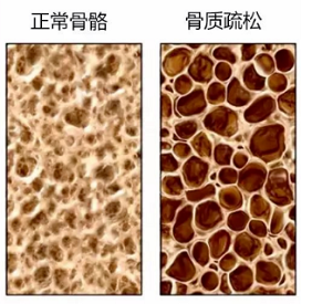 91视频下载免费检测仪生产厂家骨质疏松老年人疾病年轻人需要做91视频下载免费检测吗